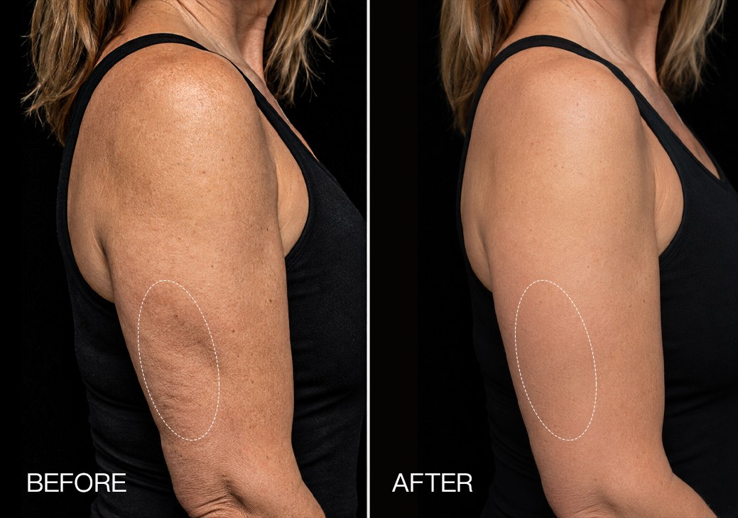 Red light therapy before and after